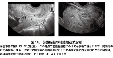 胎盤形成出血|(2)前置胎盤・癒着胎盤 – 日本産婦人科医会